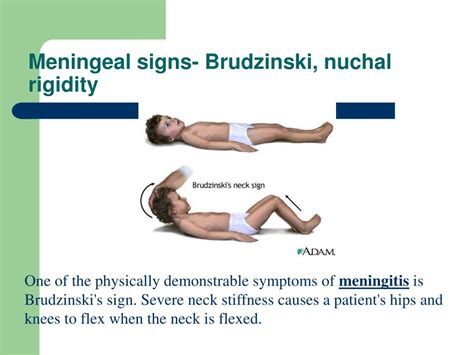 meningitis symptoms nuchal rigidity